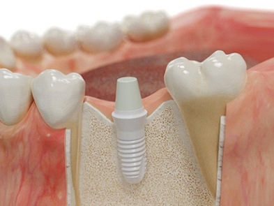 Model of an integrated dental implant in the jawbone