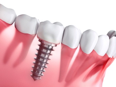 Animated dental implant fused with the lower jawbone