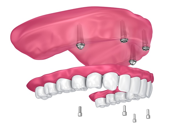 Animated All on 4 implant denture being placed in the upper arch