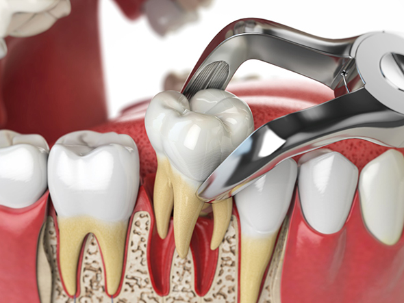 Illustration of dental forceps removing tooth