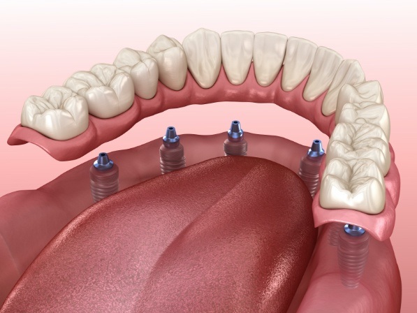 Animated implant denture being placed in lower arch