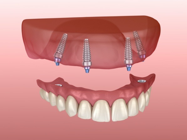 Animated All on 4 implant denture being placed in upper arch