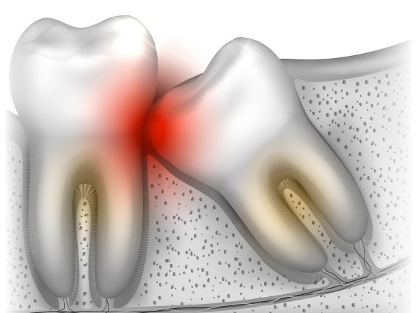 Animated close up of impacted tooth pressing against adjacent tooth