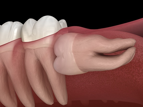 Animated impacted wisdom tooth pressing against adjacent molar