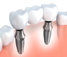 Two animated dental implants with fixed bridge