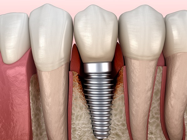 Close up of animated dental implant in the lower jaw