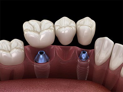 Animated dental implant with fixed bridge replacing three missing teeth