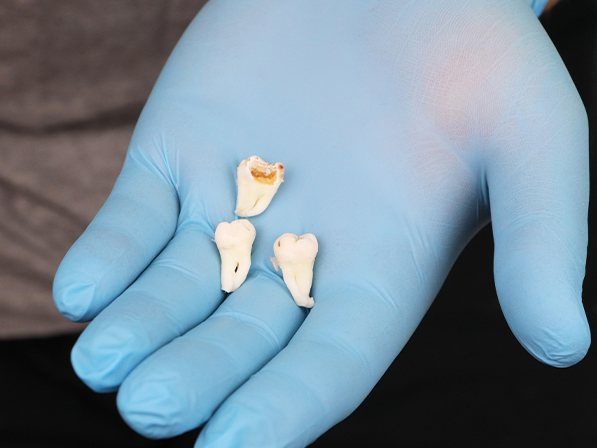 Gloved hand holding three damaged teeth after tooth extractions in Dallas