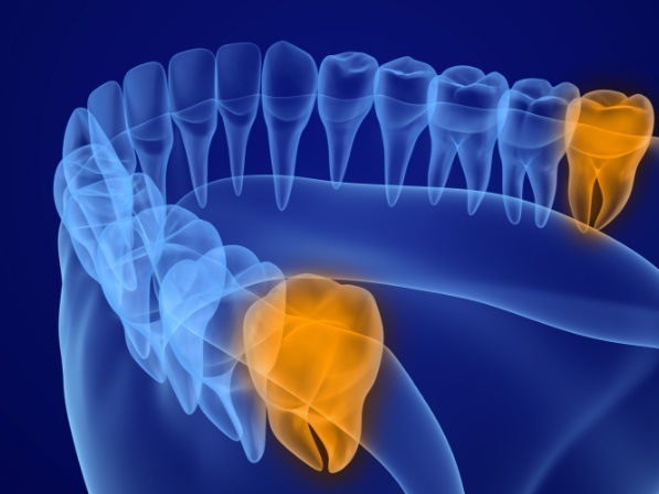 3 D animated row of teeth with highlighted wisdom teeth