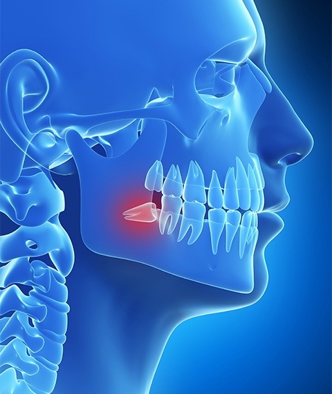 Animated smile with impacted wisdom tooth highlighted