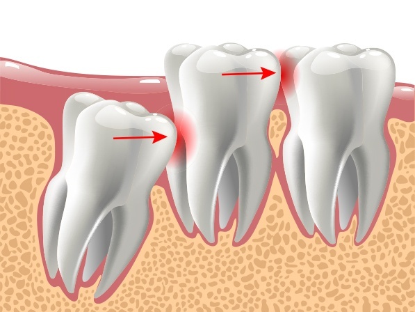 Animated close up of impacted wisdom tooth