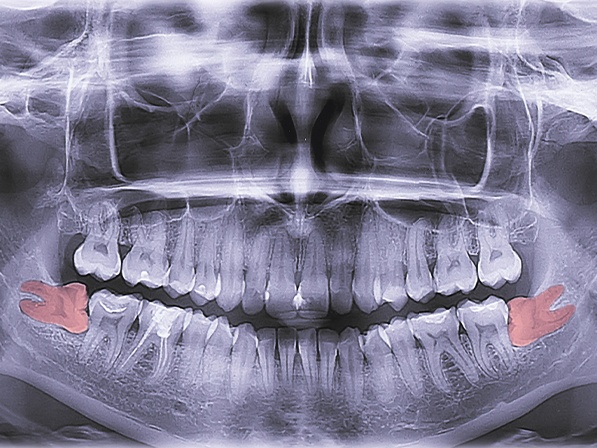 X ray of smile with wisdom teeth highlighted red