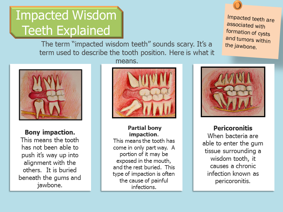 teeth moving from wisdom teeth