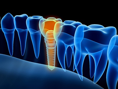 3 D rendering of dental implant in the lower jaw