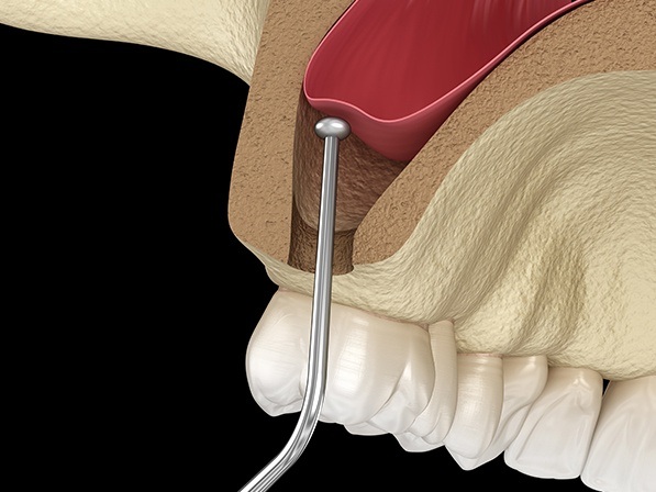 Animated upper jaw during sinus lift procedure