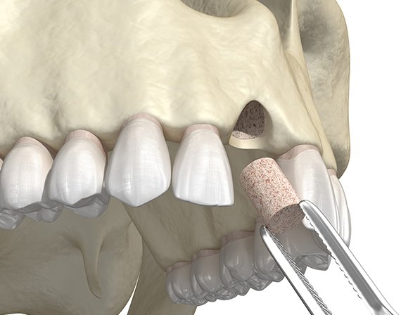 Animated bone grafting material being placed in upper jawbone