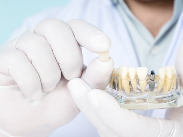 Dentist holding dental crown in one hand and model of dental implant in the other
