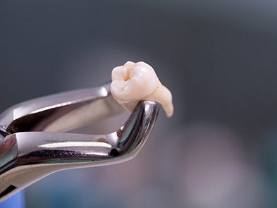 Tooth being held in a set of forceps