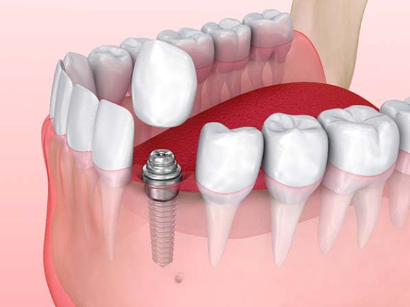 Animated dental crown being placed over a dental implant