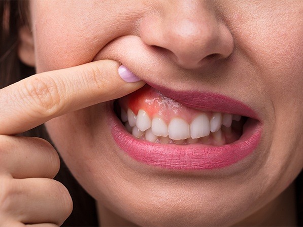 Close up of person pointing to red swollen area of their gums
