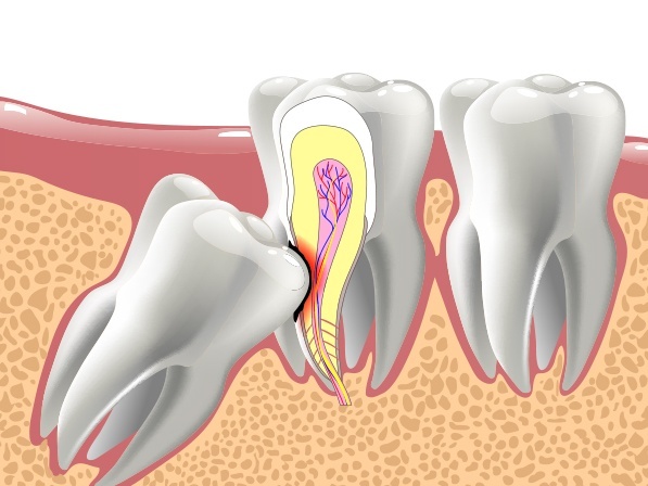 Animated impacted tooth pressing against adjacent tooth