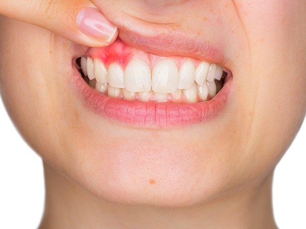 Closeup of patient with damaged smile in need of oral pathology