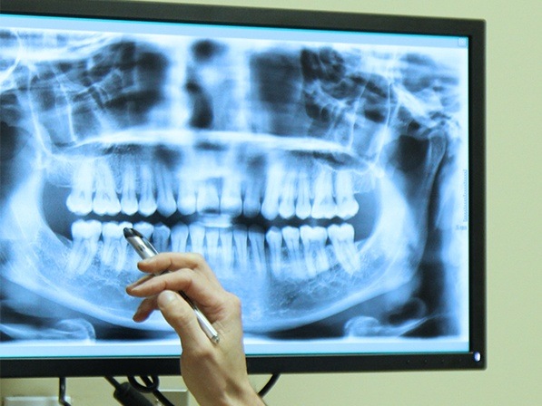 Panoramic digital dental x-rays