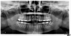 skada på intilliggande tand