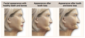 bone loss with dentures