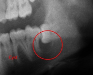 cysts in wisdom teeth