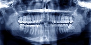 Wisdom teeth removal in Dallas is often required for the health of your smile. 