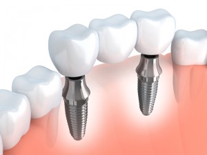 Your dentist for a dental implant in Dallas.