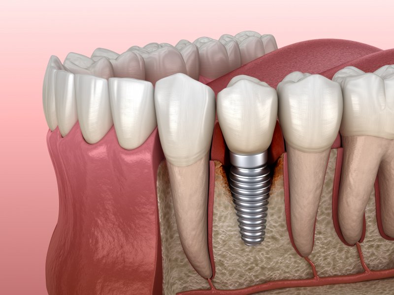 failed dental implant