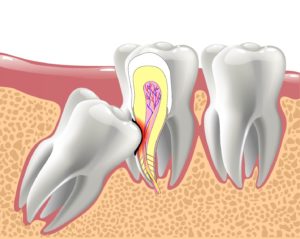 Illustration of an impacted wisdom tooth.