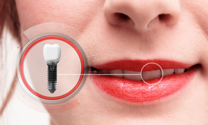 Close-up of smile with a picture of a dental implant
